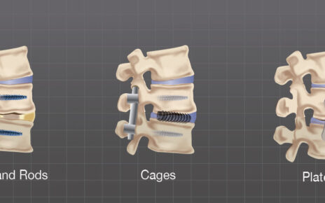 Spinal Implants And Surgical Devices Market